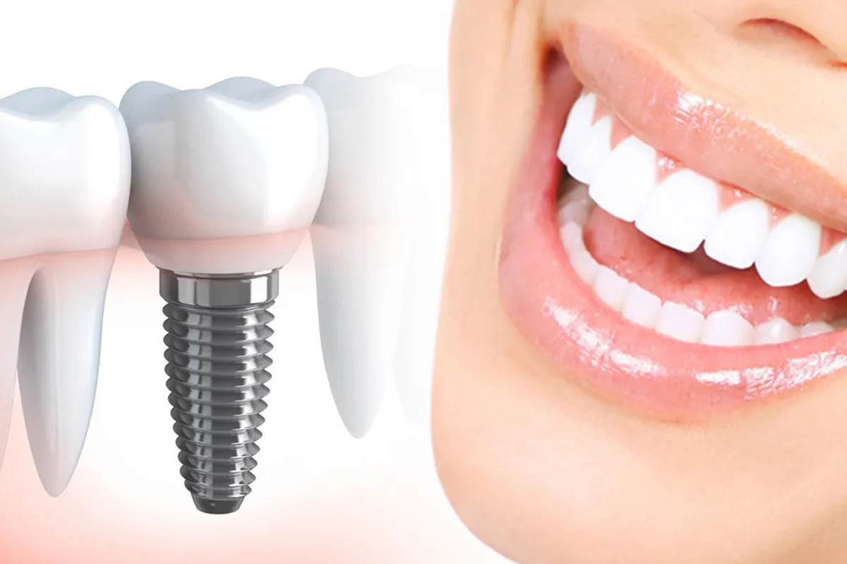 What Patients Should Know About Aftercare for Dental Implant Duration